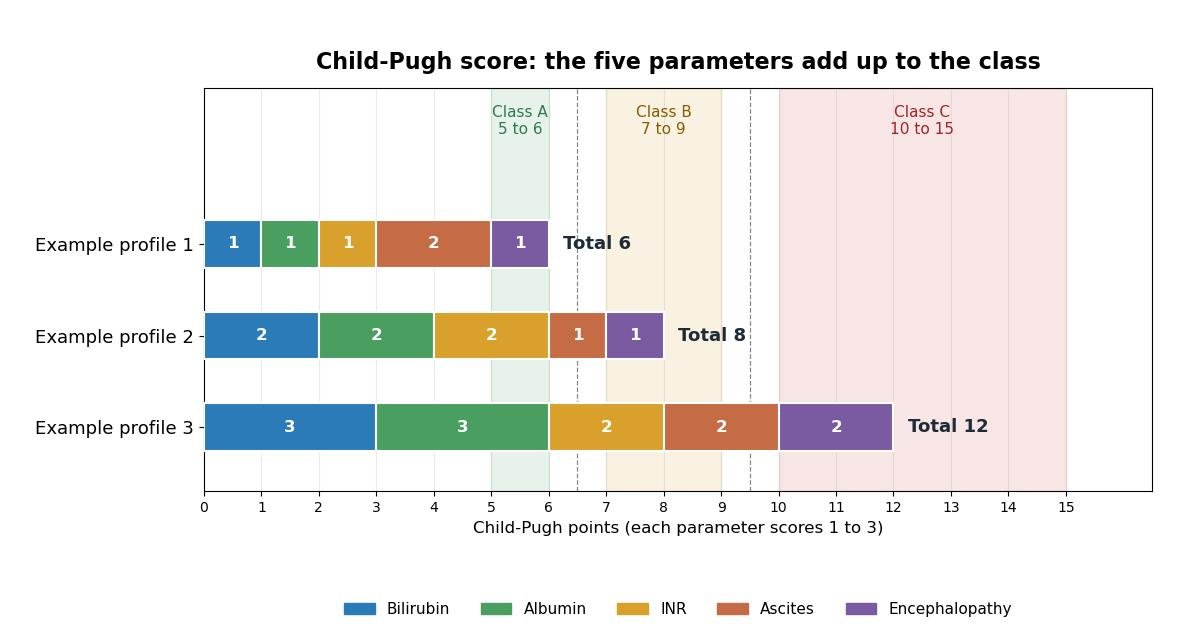 Stacked bar chart of the Child-Pugh score: the five parameters (bilirubin, albumin, INR, ascites, encephalopathy) each contribute 1 to 3 points, shown for three example profiles totalling 6 (Class A, 5 to 6), 8 (Class B, 7 to 9) and 12 (Class C, 10 to 15), with the three class bands shaded on the 0 to 15 scale