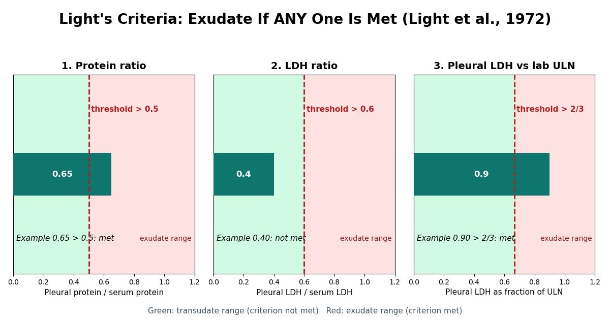 Chart of Light's three criteria with exudate thresholds: protein ratio above 0.5, LDH ratio above 0.6, pleural fluid LDH above two-thirds of the laboratory upper limit of normal