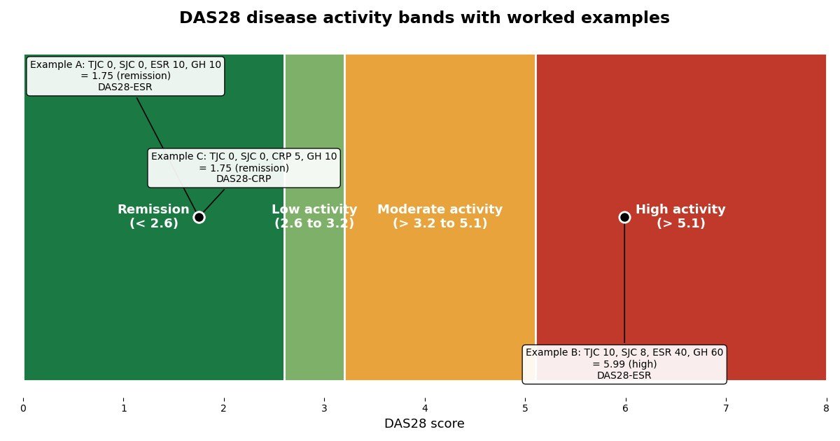 Chart of DAS28 disease activity bands from remission to high activity, with three worked calculation examples